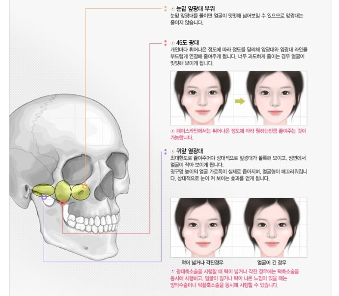 大颧骨磨骨整容整形手术介绍 大颧骨磨骨整形前后对比图