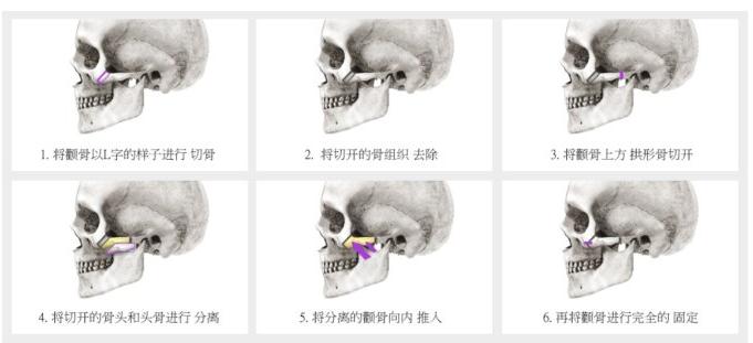 怎样才能让颧骨增高 颧骨增高整形充填增高术