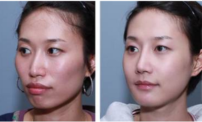 脸部颧骨整形手术前后对比图