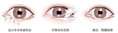 开内眼角会回缩吗 开内眼角前后对比图 开内眼角会回缩吗 开内眼角前后对比图