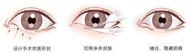开内眼角会回缩吗 开内眼角前后对比图
