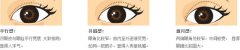 双眼皮和欧式双眼皮对比照片与区别