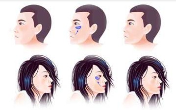 什么是颧骨整形手术 颧骨颧弓骨折手术方法