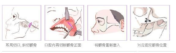 【磨骨手术】磨骨瘦脸手术多少钱 磨骨手术对比照片