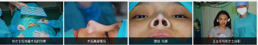 【北京隆鼻修复】北京专业隆鼻医生隆鼻失败修复专家哪个好