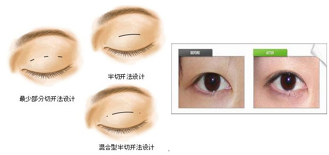 什么是切开法重睑成形术
