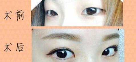 什么是切开法重睑成形术
