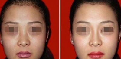 注射玻尿酸隆鼻有哪些危害 注射玻尿酸隆鼻前需要注意什么