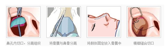 自体软骨隆鼻尖