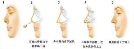 自体软骨隆鼻尖