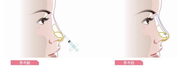 注射玻尿酸隆鼻前后应注意什么