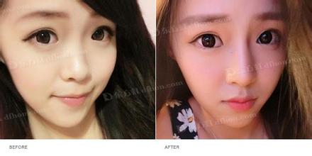 注射玻尿酸隆鼻前后应注意什么