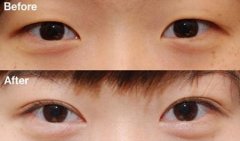三点双眼皮是怎么做的 三点式双眼皮多久可以修复 三点双眼皮是怎么做的 三点式双眼皮多久可以修复