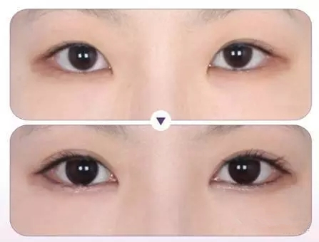 三点式双眼皮