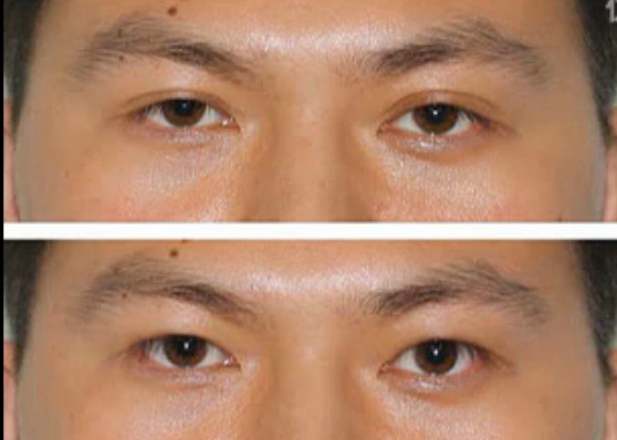 有没有双眼皮变单眼皮的方法 怎样把双眼皮变成单眼皮