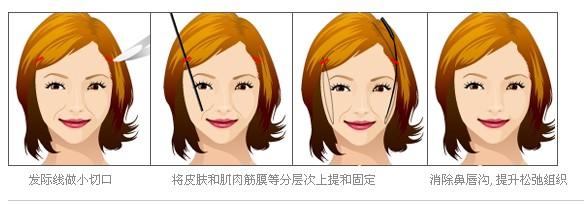 面b提升术