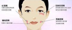人造酒窝术后会不会影响面部表情自然