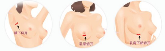 假体隆胸