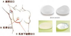 假体隆胸术后如何护理