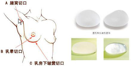 假体隆胸术