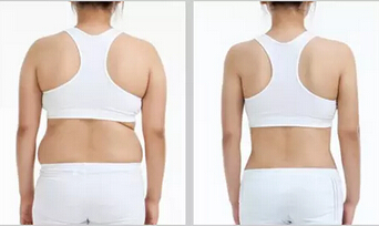 吸脂减肥降低风险吗吸脂减肥果好吗