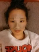 【自体肋软骨隆鼻】自体肋软骨隆鼻优点 自体肋软骨隆鼻对比图 【自体肋软骨隆鼻】自体肋软骨隆鼻优点 自体肋软骨隆鼻对比图