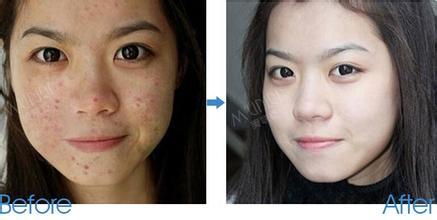 祛痘无误区让痘痘紧随你