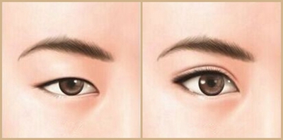 【双眼皮手术】双眼皮手术有哪几种 割双眼皮手术后遗症