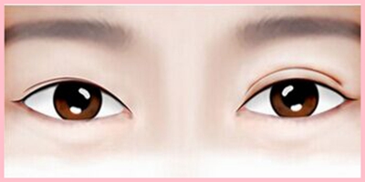 【双眼皮手术】双眼皮手术有哪几种 割双眼皮手术后遗症