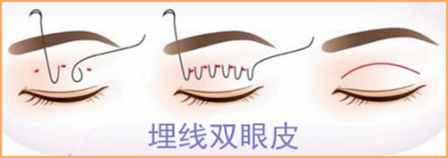 【双眼皮手术】双眼皮手术有哪几种 割双眼皮手术后遗症