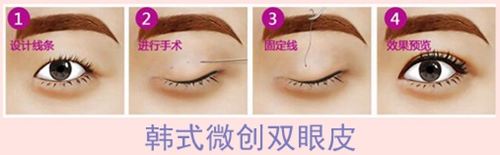【双眼皮手术】双眼皮手术有哪几种 割双眼皮手术后遗症