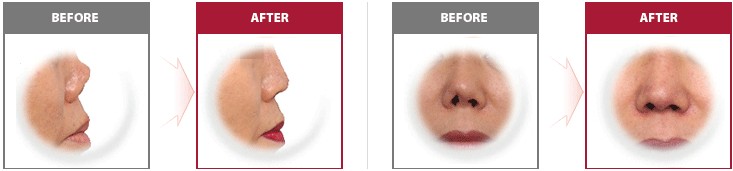 朝天鼻矫正术多少钱