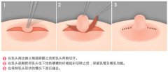 巨大乳房缩小术果怎么样 巨大乳房缩小术只是切除多余组织吗