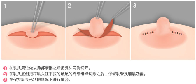 巨大乳房缩小手术