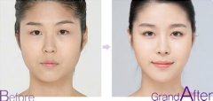 韩国割双眼皮手术多少钱?怎么样? 韩国割双眼皮手术多少钱?怎么样?