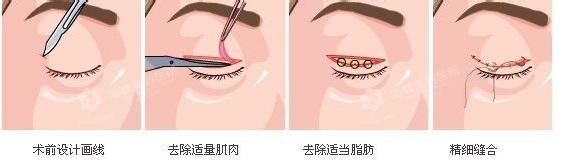 韩国割双眼皮手术多少钱?怎么样?