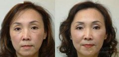 简单有去眼袋方法 眼袋去除手术 简单有去眼袋方法 眼袋去除手术