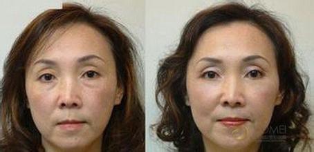 简单有去眼袋方法 眼袋去除手术