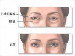 疤痕体质能做去眼袋手术吗 疤痕体质怎么去眼袋 疤痕体质能做去眼袋手术吗 疤痕体质怎么去眼袋