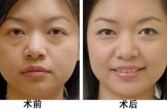 疤痕体质能做去眼袋手术吗 疤痕体质怎么去眼袋