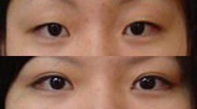 三点定位双眼皮手术果如何 三点定位双眼皮手术案例图