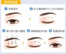 三点定位双眼皮手术果如何 三点定位双眼皮手术案例图 三点定位双眼皮手术果如何 三点定位双眼皮手术案例图
