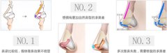 自体软骨隆鼻有什么优势 自体软骨隆鼻有什么优势