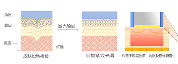 激光去皱有副作用没 激光美白去皱术果怎么样