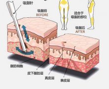大腿吸脂手术6大注意事项 大腿吸脂手术6大注意事项
