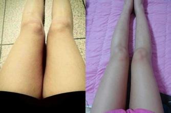 大腿吸脂手术6大注意事项
