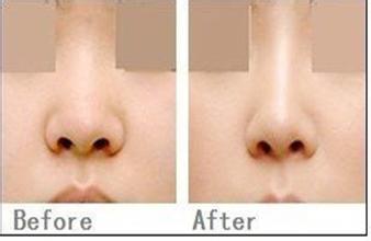 鼻孔缩小手术前后对比图