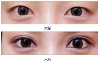 三点定位双眼皮恢复成好吗 三点定位双眼皮果案例图