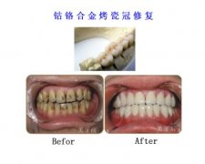 钴铬合金烤瓷牙和钛合金哪种好