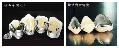 钴铬合金烤瓷牙和钛合金哪种好